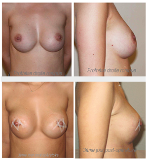 la rupture d'un implant mammaire peut passé inaperçu